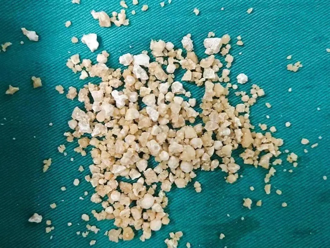 门医技术丨泌尿结石足不出区微通道解决大问题