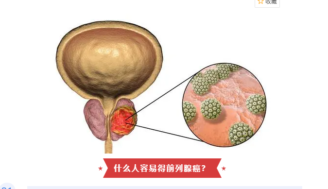 01老年人年龄是前列腺癌的最大危险因素,患者年龄越大,患病几率越大