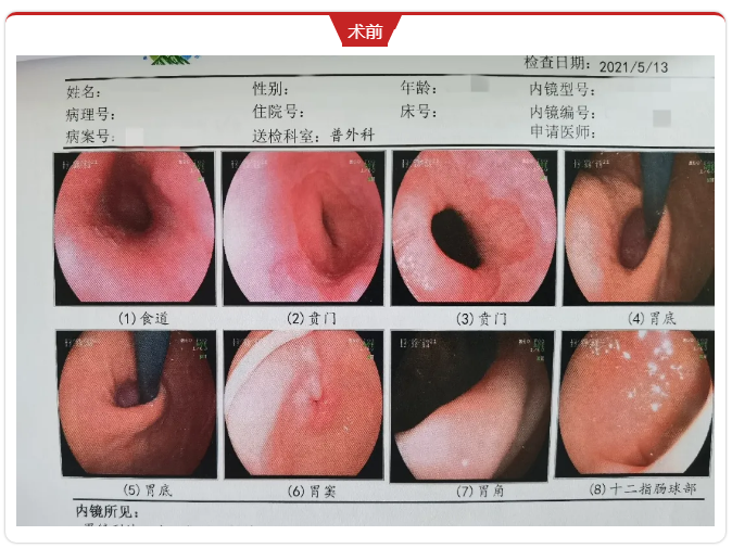 好消息门头沟区医院成功完成首例腹腔镜下食道裂孔疝修补术胃底折叠术